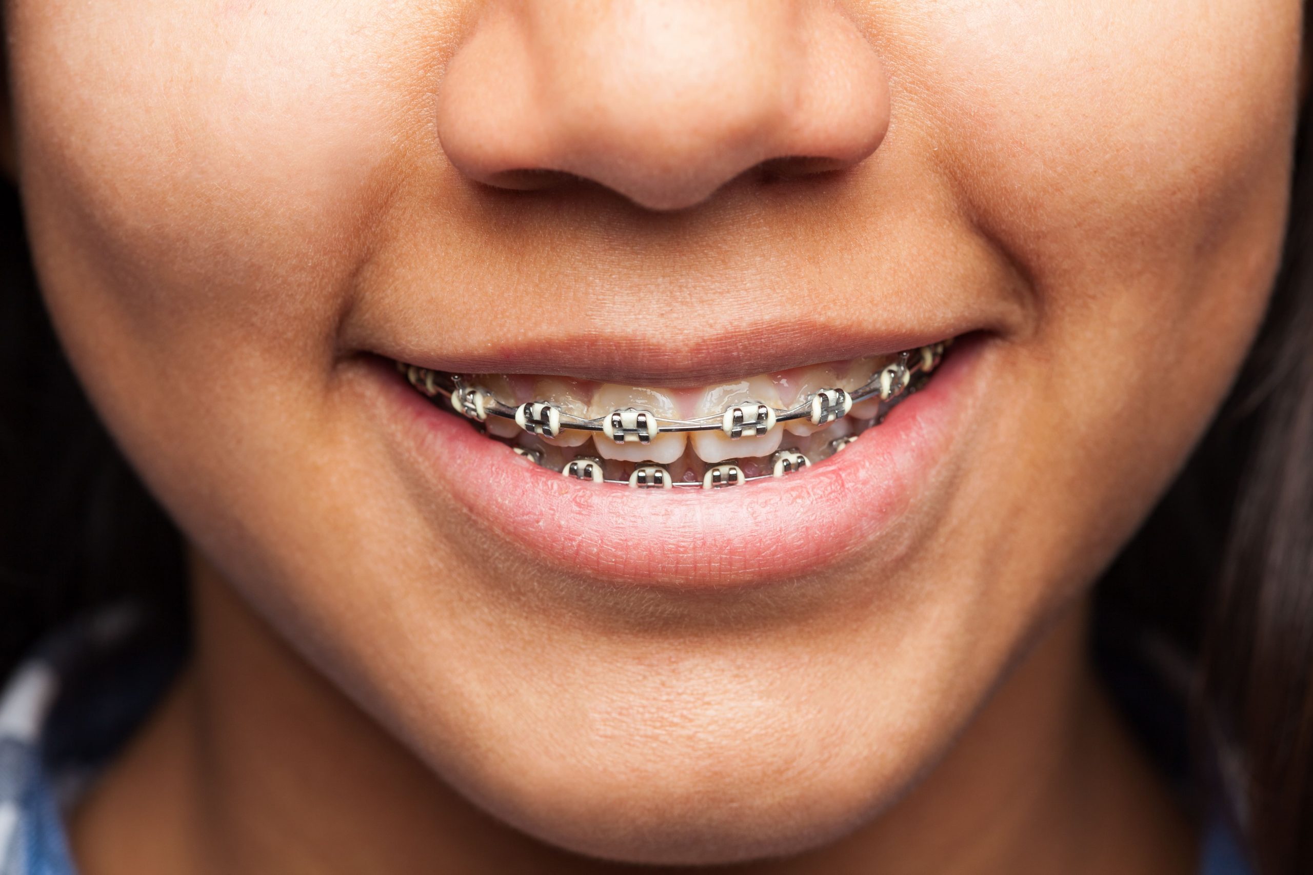 Achieving a Perfect Smile: The Science Behind Modern Braces