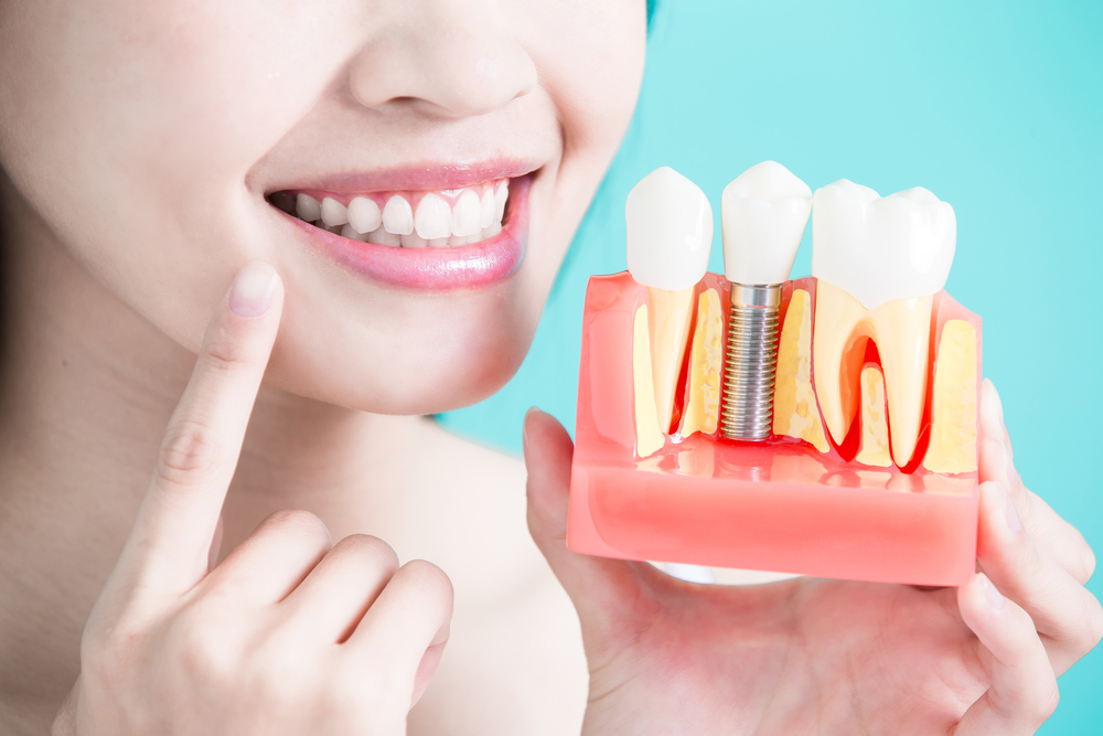 The Journey of Dental Implants: From Consultation to Care